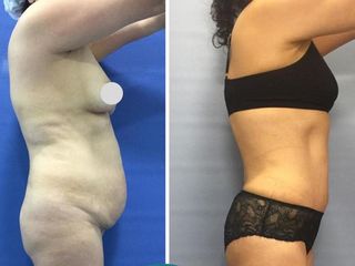 ABDOMINOPLASTIA 2