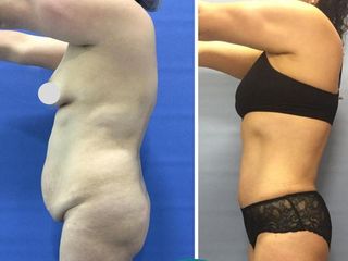 ABDOMINOPLASTIA 3