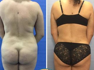 ABDOMINOPLASTIA 4