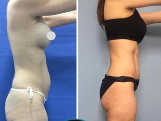 LIPOSUCCIÓN 2