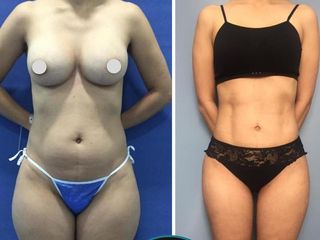 LIPOSUCCIÓN 3