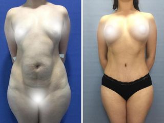 AUMENTO DE MAMA Y LIPOSUCCIÓN 1