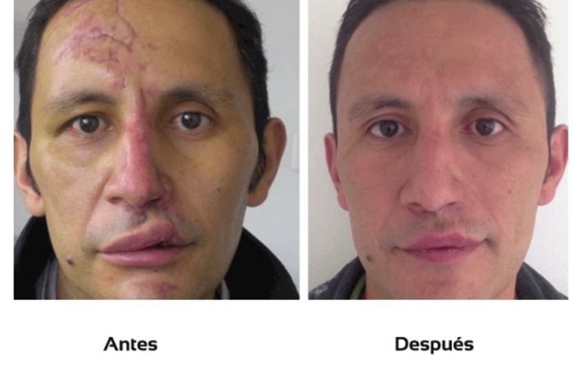 Cicatrices antes y después - 511060