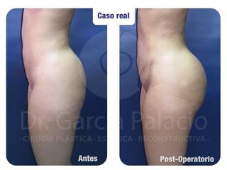 GLUTEOPLASTIA