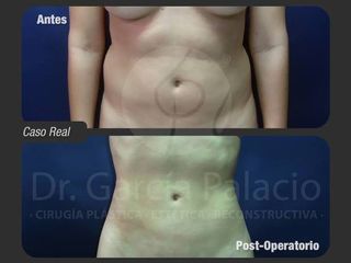 LIPO 