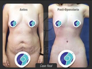 Antes y despues de dermolipectomia