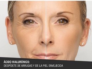 Antes y despues de acido hialuronico