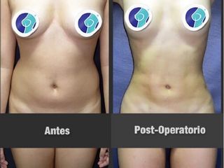 Antes y despues de liposuccion