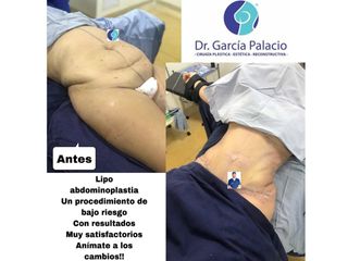 Lipoescultura