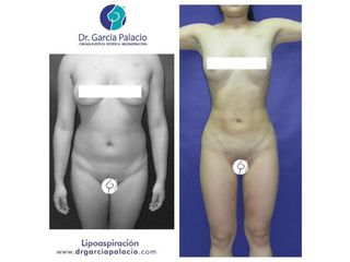 Liposucción