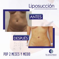 Liposucción - Dr. García Palacio