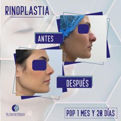 Rinoplastia - Dr. García Palacio