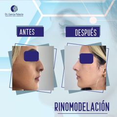 Rinomodelación - Dr. García Palacio