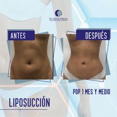 Liposucción - Dr. García Palacio