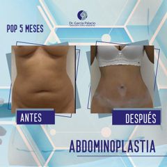 Abdominoplastia - Dr. García Palacio
