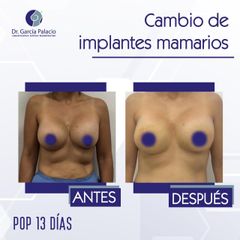 Cambio de implantes - Dr. García Palacio