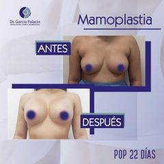 Mamoplastia de aumento - Dr. García Palacio