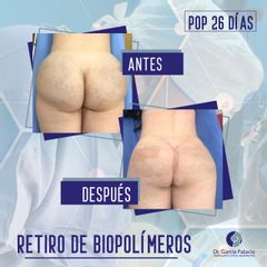 Gluteoplastia - Dr. García Palacio