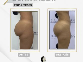 Retiro de Biopolímeros antes y después - 829561