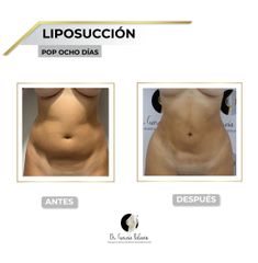 Liposucción - Dr. García Palacio