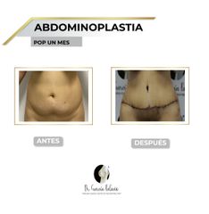 Abdominoplastia - Dr. García Palacio