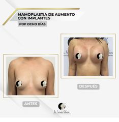 Mamoplastia de aumento - Dr. García Palacio