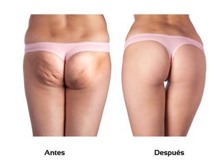 Mesoterapia