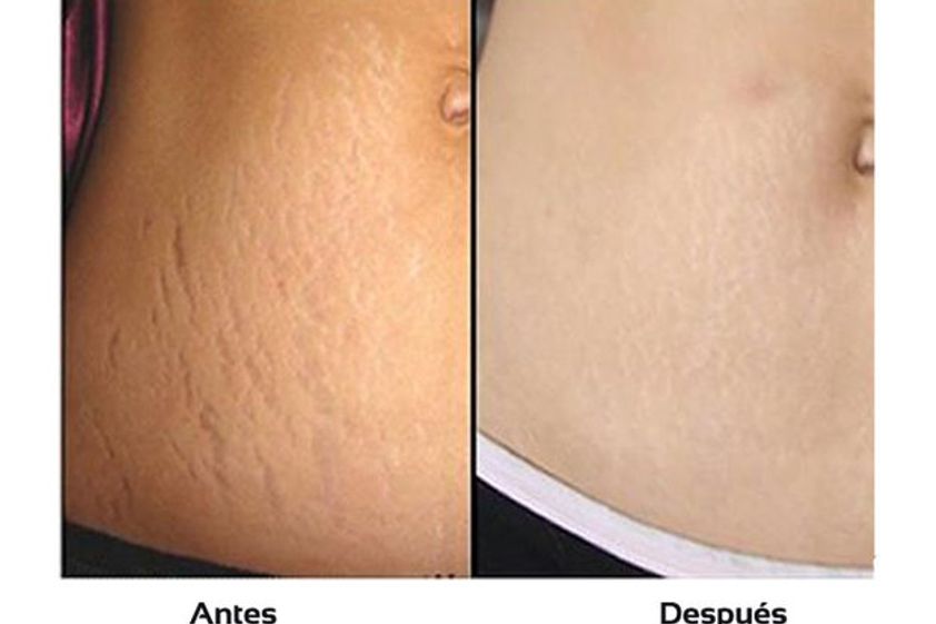Eliminar estrías antes y después - 511225