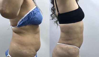 Lipolisis Láser - Robledo & Robledo Medicina Estética