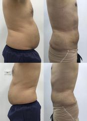 Lipolisis Láser - Robledo & Robledo Medicina Estética