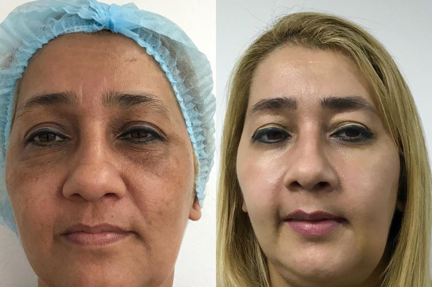 Peeling antes y después - 776495