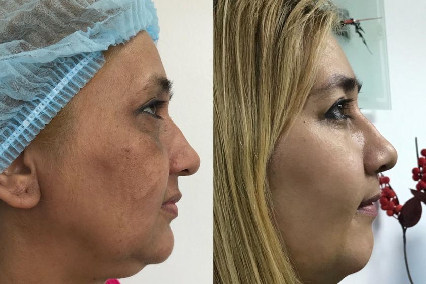 Peeling antes y después - 776496