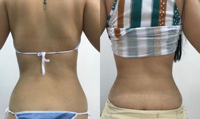 Lipolisis Láser - Robledo & Robledo Medicina Estética