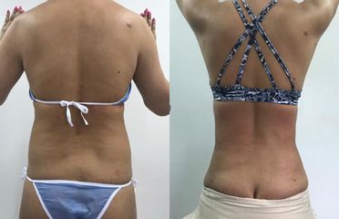 Lipolisis Láser - Robledo & Robledo Medicina Estética