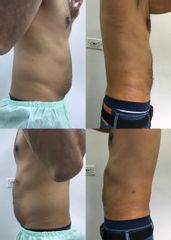 Lipolisis Láser - Robledo & Robledo Medicina Estética