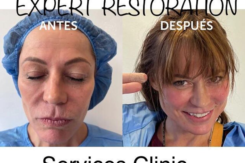 Lifting facial antes y después - 855790