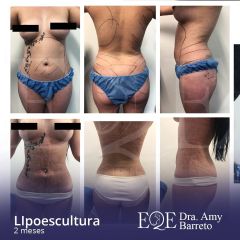 Lipoescultura - Dra. Amy Barreto