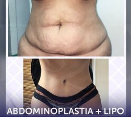 Abdominoplastia - Dra. Amy Barreto