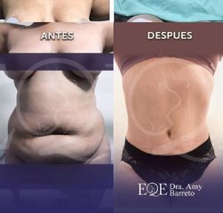 Abdominoplastia - Dra. Amy Barreto