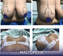 Mamoplastia de reducción - Dra. Amy Barreto