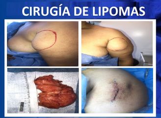 Lipoma - Dra. Amy Barreto