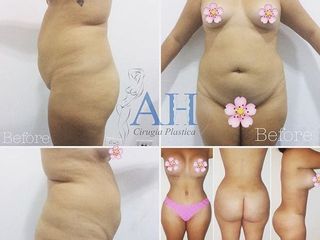 LIPOESCULTURA + ABDOMINOPLASTIA + LEVANTAMIENTO DE SENOS