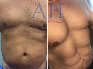 MARCACIÓN ABDOMINAL 