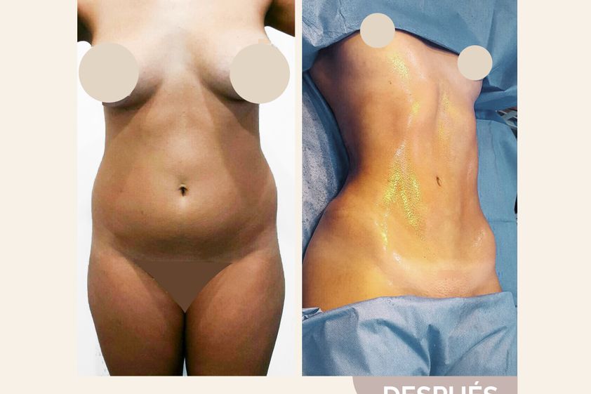 Liposucción antes y después - 814499
