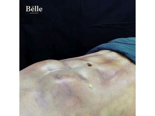 Lipoescultura Marcacion Abdominal - Clinica Belle