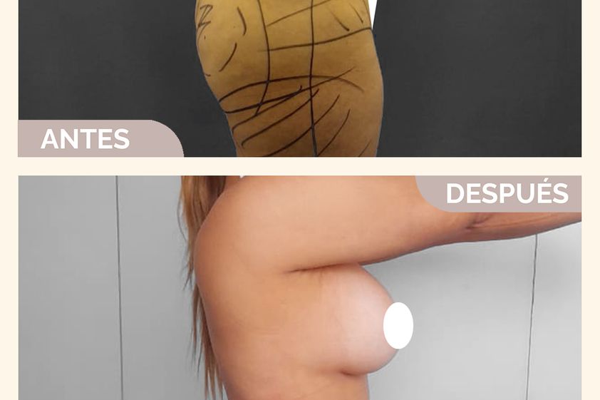 Lipoescultura antes y después - 861388