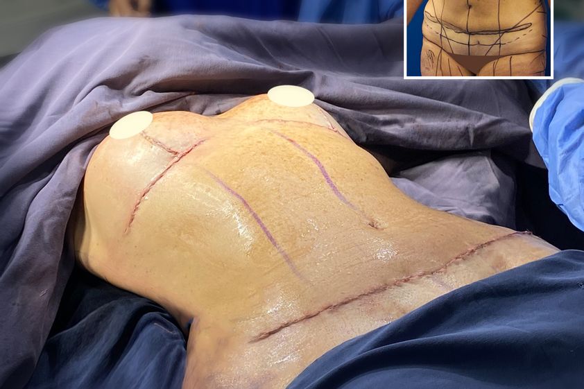 Abdominoplastia antes y después - 861390