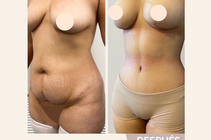 Lipoescultura antes y después - 861392
