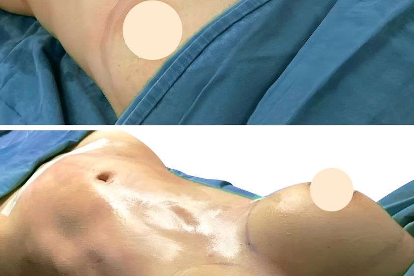Mamoplastia de aumento antes y después - 861394