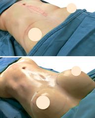 Mamoplastia de aumento - Belle Cirugía Plástica